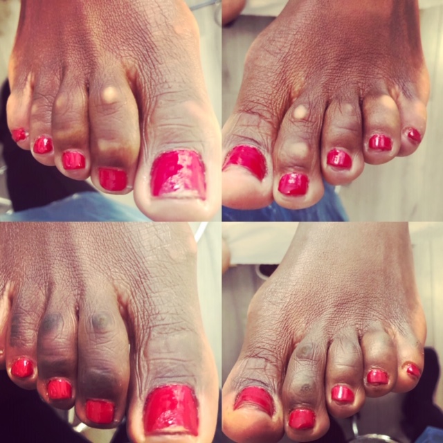 skin camouflage pigmentation on toes feet