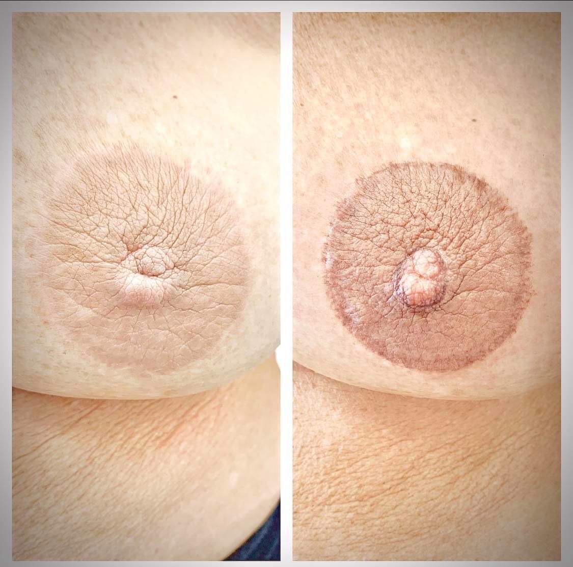 areola pigmentation London