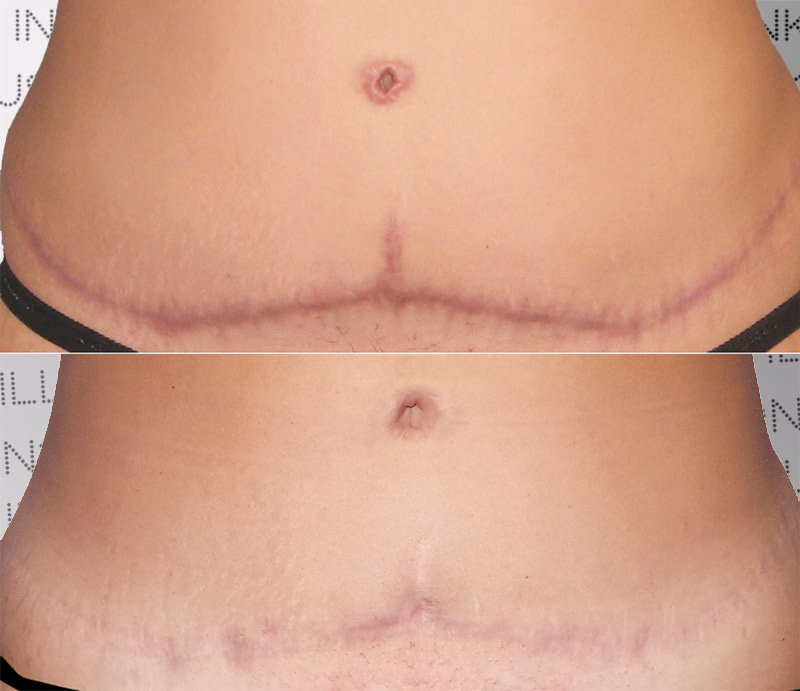 tummy tuck scar treatment london
