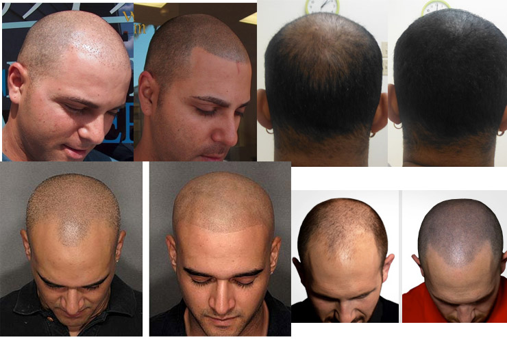 men scalp micropigmentation smp