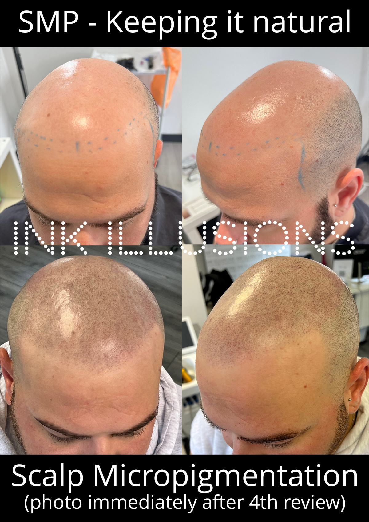 natural scalp micropigmentation london