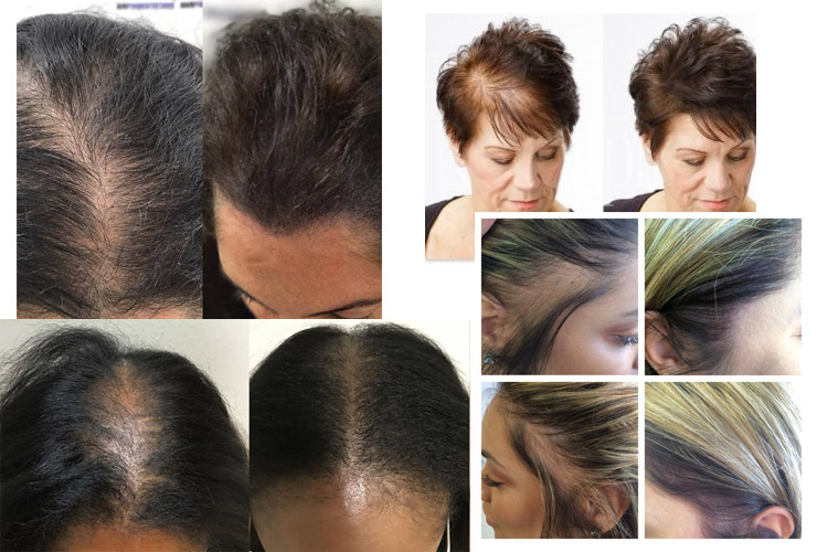 women thinning hair scalp micropigmentation density