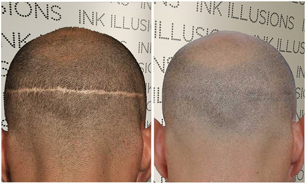 head scalp scar camouflage before after