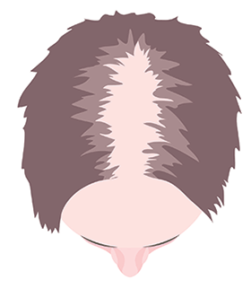 women alopecia hair loss tattooing