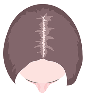 women hair loss receding parting and hairline