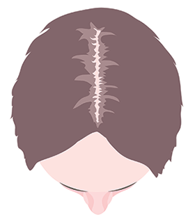 women hair loss receding parting