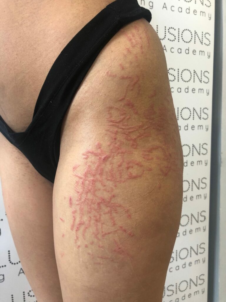 MCA needling straight after
