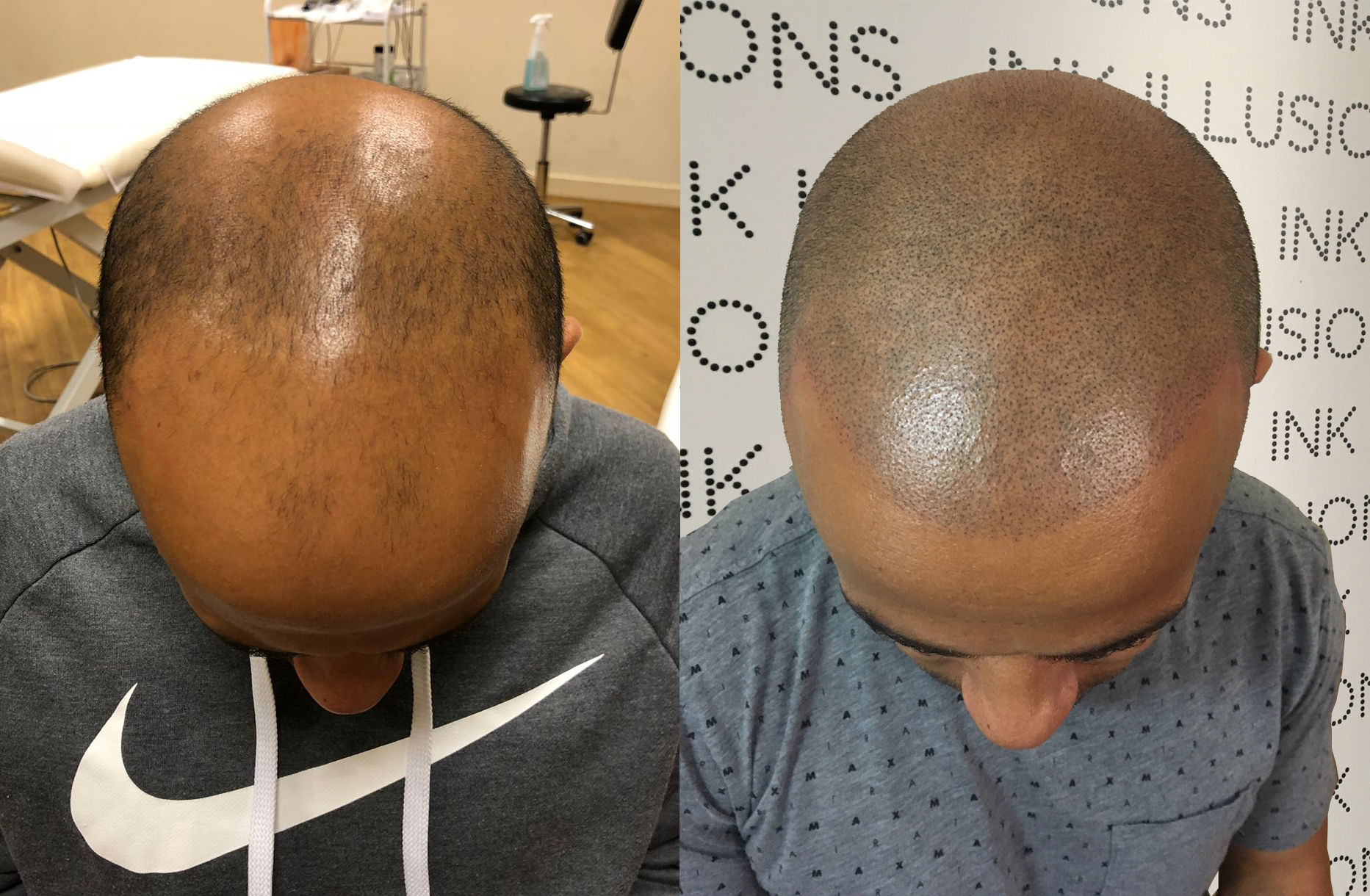 antony scalp micropigmentation london before after