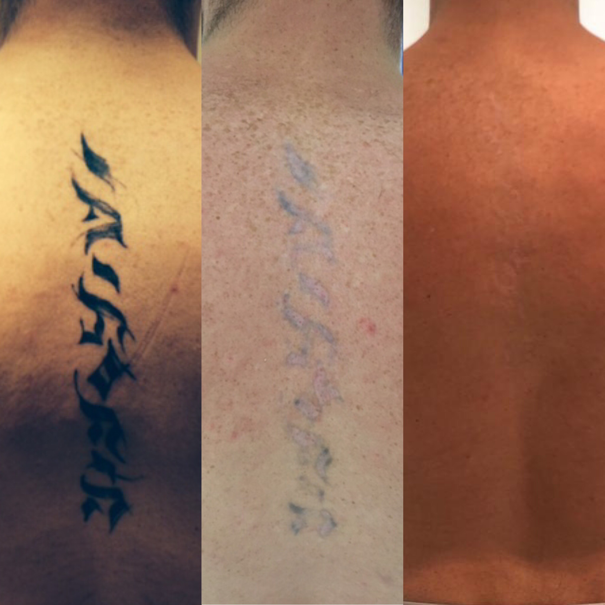 before after laser tattoo removal hertfordshire