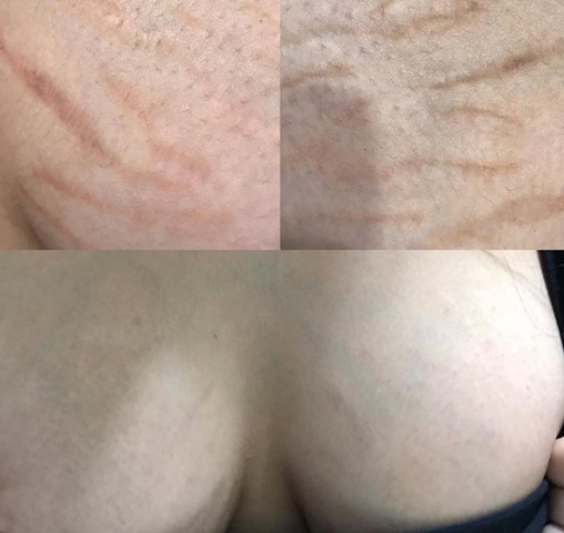 breast stretch marks camouflage breast stretch marks camouflage