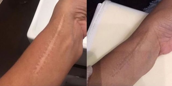wrist scar camouflage with tattooing wrist scar camouflage with tattooing