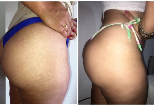 bum stretch mark camouflage tattoo bum stretch mark camouflage tattoo