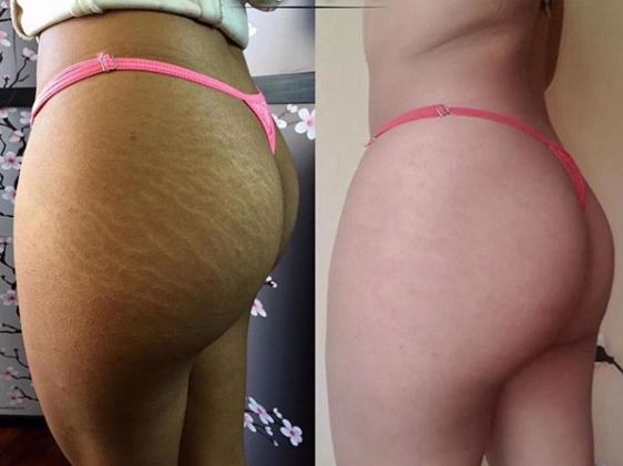 Image credit Novique Studio, Sweden - stretch mark camouflage by skin tone tattoo ink Image credit Novique Studio, Sweden - stretch mark camouflage by skin tone tattoo ink