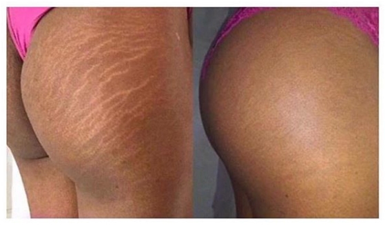 bottom stretch mark removal with tattoo ink bottom stretch mark removal with tattoo ink