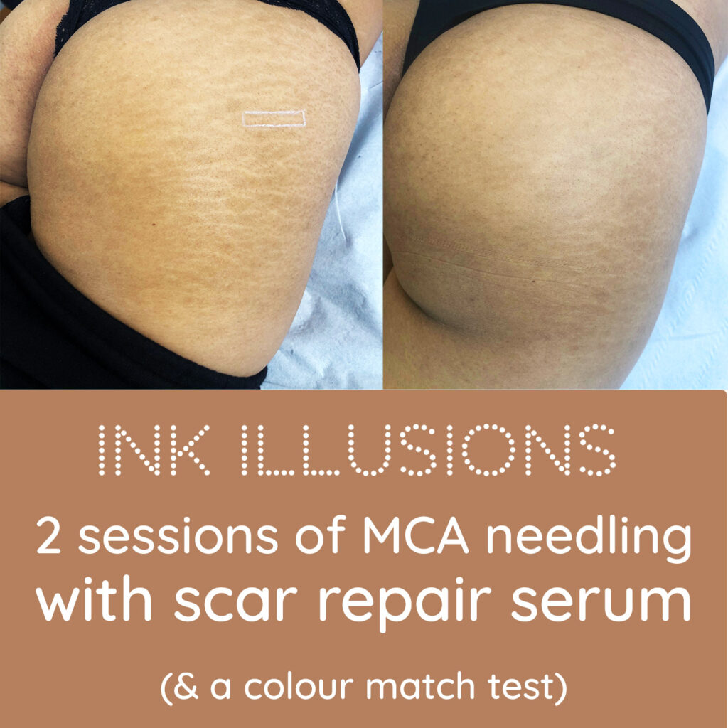 before after MCA needling stretch marks