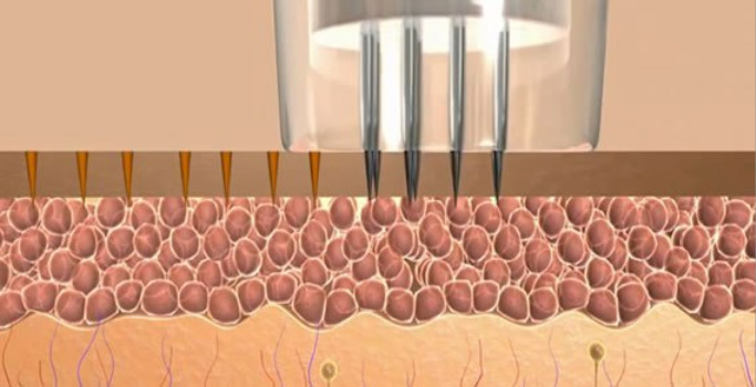 MCA NEEDLING CAUSES CHANNELS IN SKINQ