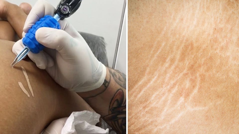 stretch mark tattoo camouflage London