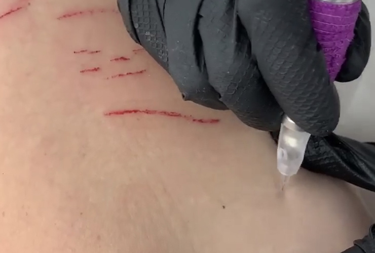 dry tattooing stretch marks treatment