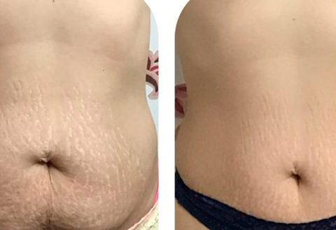 stretch mark tattoo cover up stomach