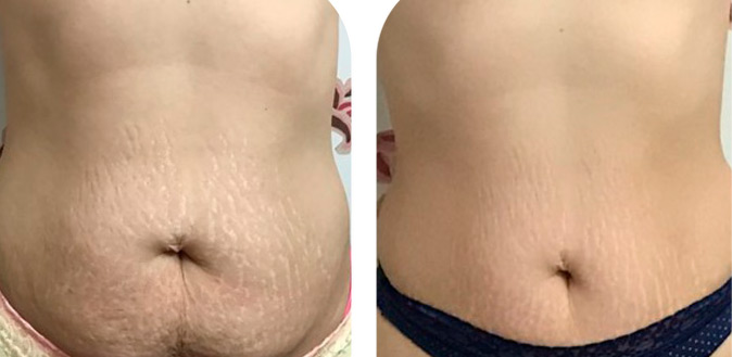 stretch mark tattoo cover up stomach