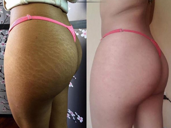 stretch mark treatment London UK