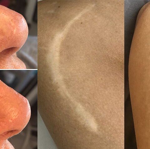 can scars be camouflaged with tattoo ink
