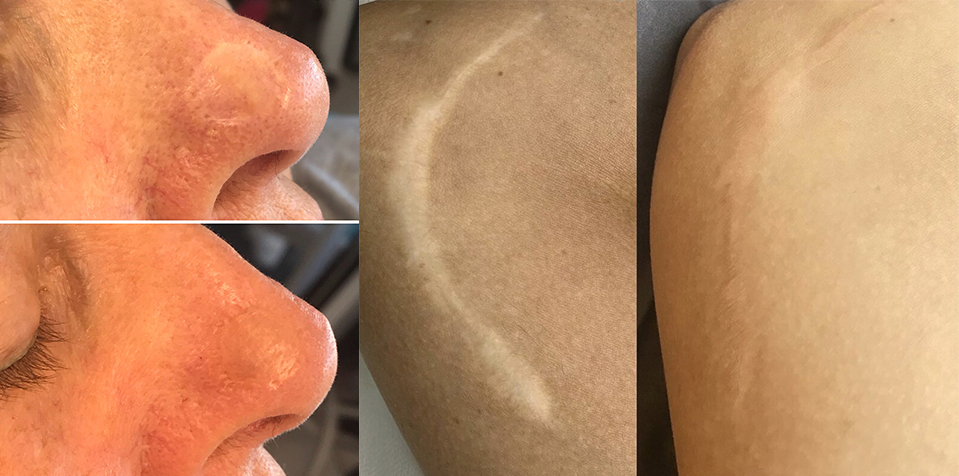 can scars be camouflaged with tattoo ink