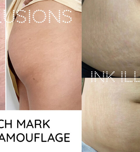 should you tattoo stretch marks