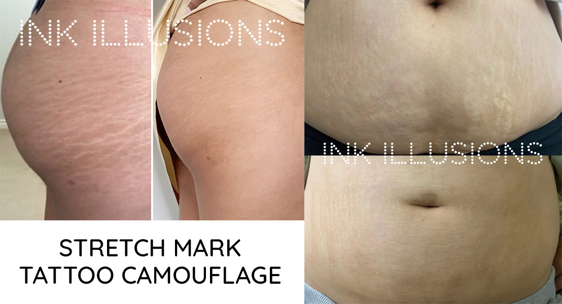 should you tattoo stretch marks