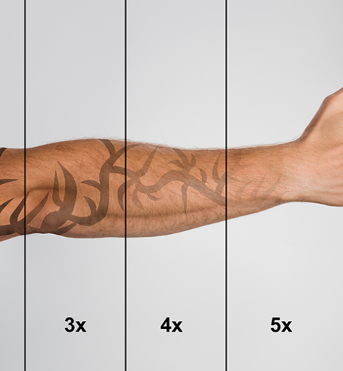 how many sessions will I need laser tattoo removal