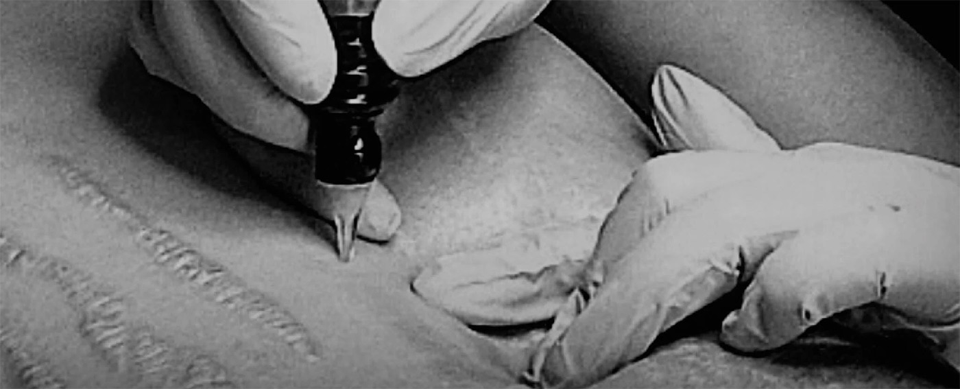 MCA dry needling image