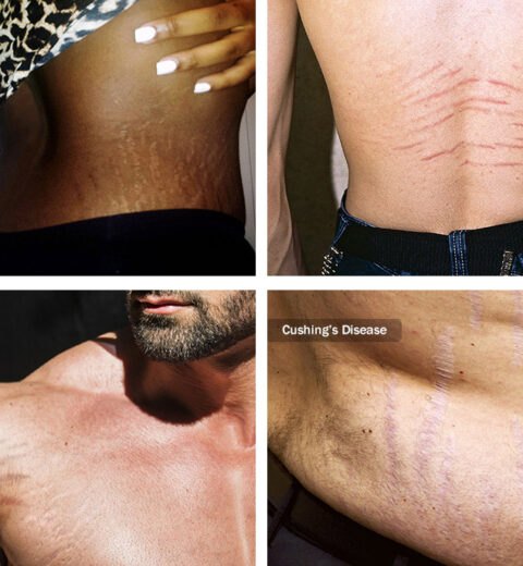 brazilian stretch mark tattoo camouflage