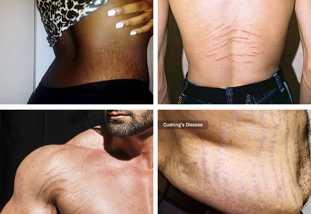 brazilian stretch mark tattoo camouflage