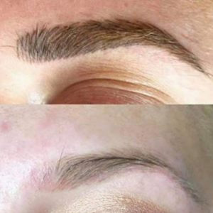 emergency eyebrow tattoo removal li-ft