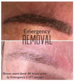 emergency eyebrow removal