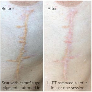 skin tone tattoo removal