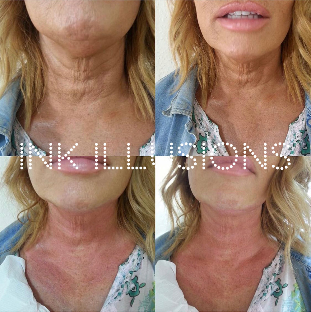 microneedling online training