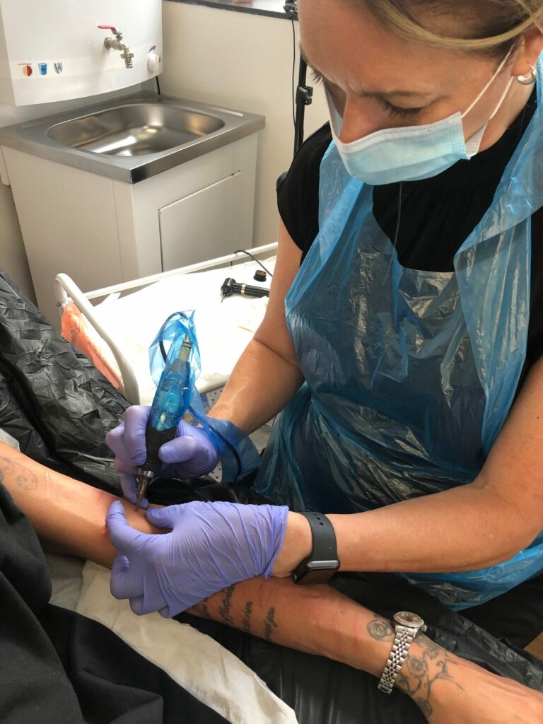 MCA needling lorraine