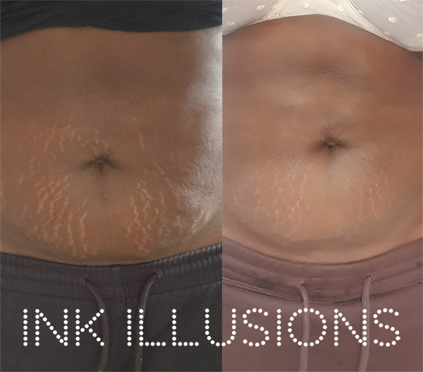 stomach strech mark treatment
