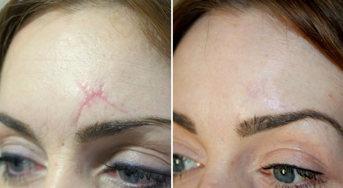 scar treatment