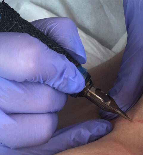 MCA inkless needling skin close up