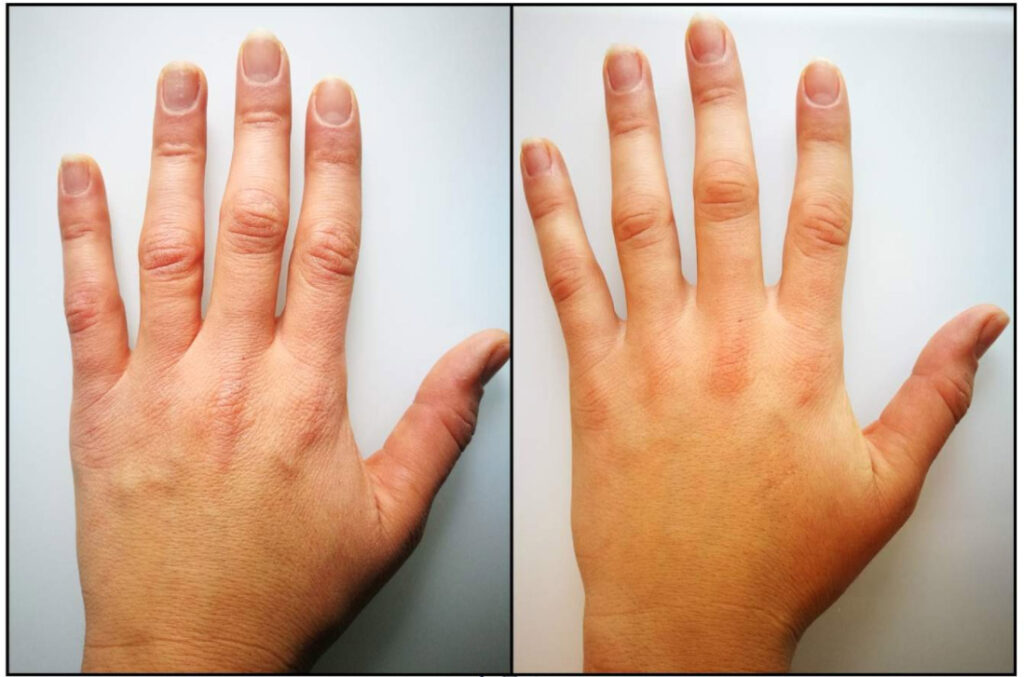 hands after TCI biorepeel