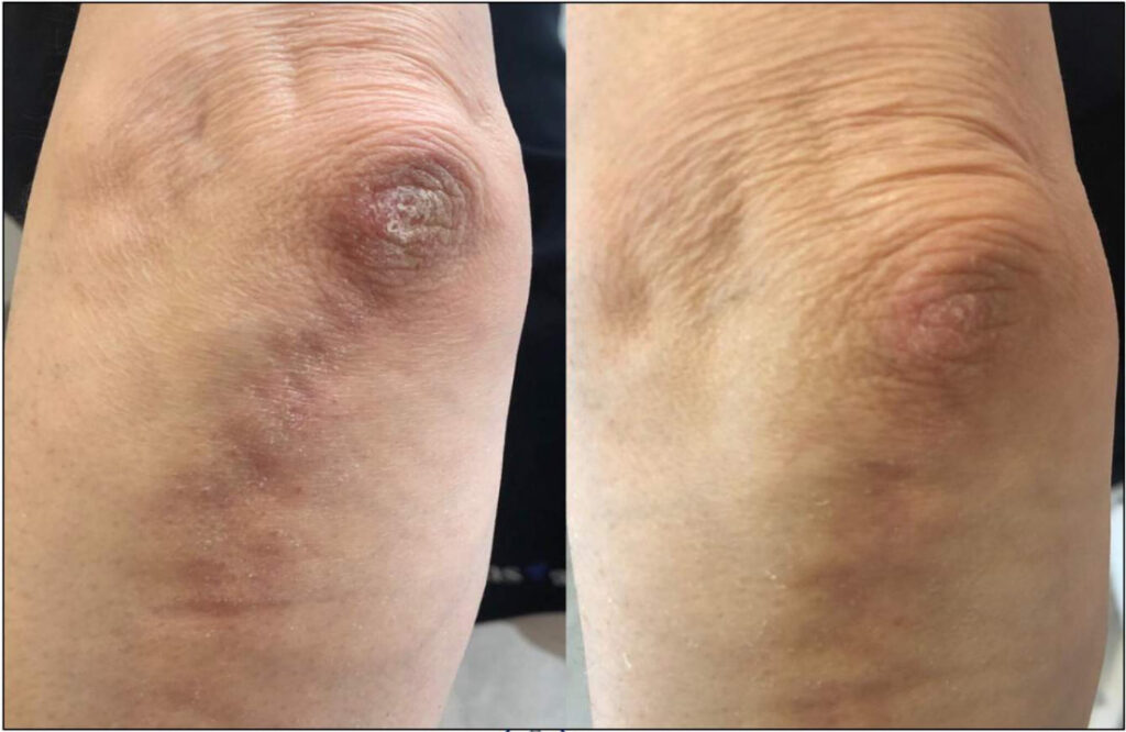 elbow pigmentation lightening treatment
