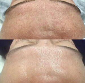 best face peel