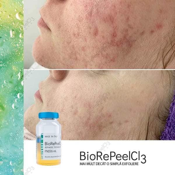 biorepeel acne scarring face peel