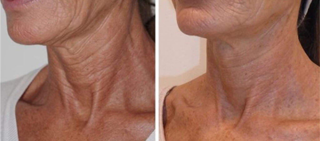TCI medium peel Biorepeel