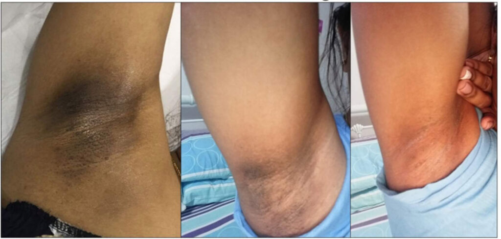 under arm pigmentation lightening treatment