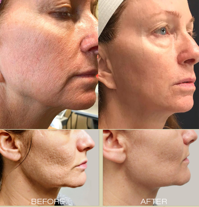 face skin tightening RF and microneedling