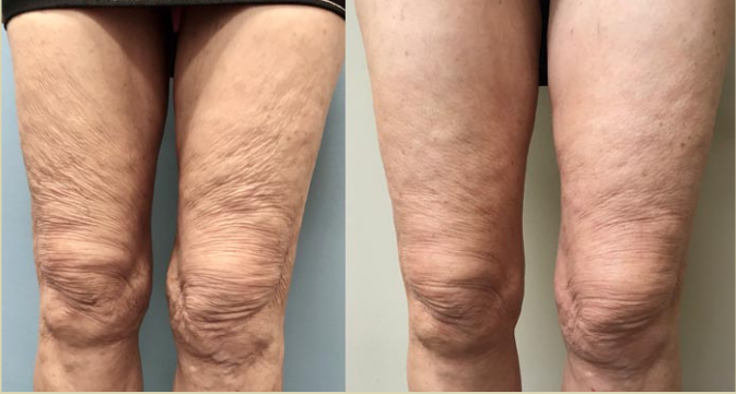 thigh skin tightening witih radiofrequency and microneedlng