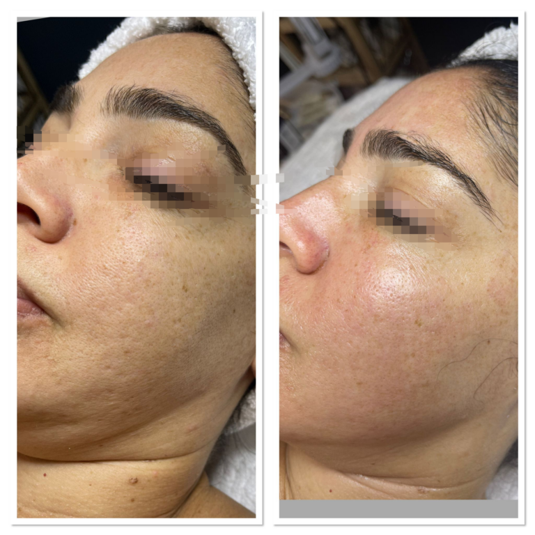 Morpheus8 Subdermal RF microneedling